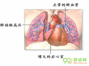 心肌病